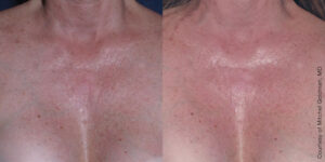 Ultherapy 0005 0093AH 0Day BEFORE AFTER Chest