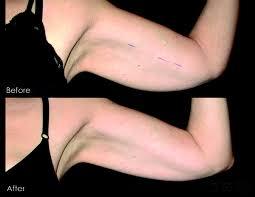 arm-Before After