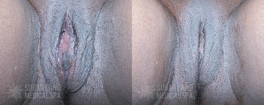 Patient 10 Non-Invasive Tightening Before and After