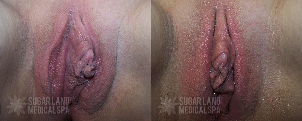 Patient 14 Non-Invasive Tightening Before and After