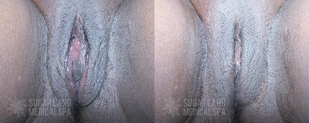 Patient 17 Non-Invasive Tightening Before and After