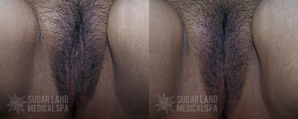 Patient 9 Non-Invasive Tightening Before and After