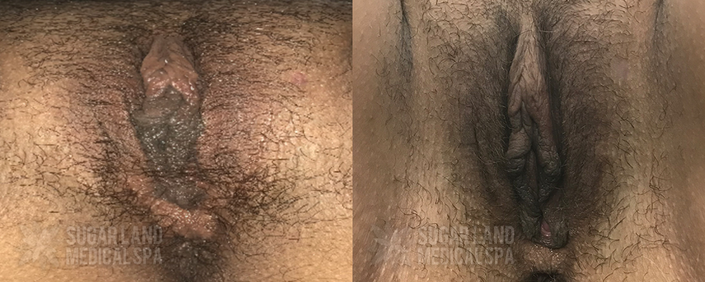 Patient 21 Non-invasive Tightening Emfemme Before and After