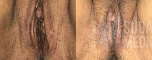 Sugar Land Medspa BA CJ Vaginoplasty