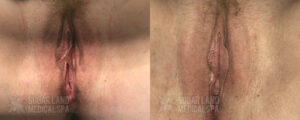 Sugarland Vaginoplasty Perineoplasty patient 3