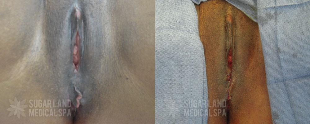 Patient 1 Vaginoplasty and Perineoplasty Before and After