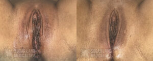 vaginoplasty patient3