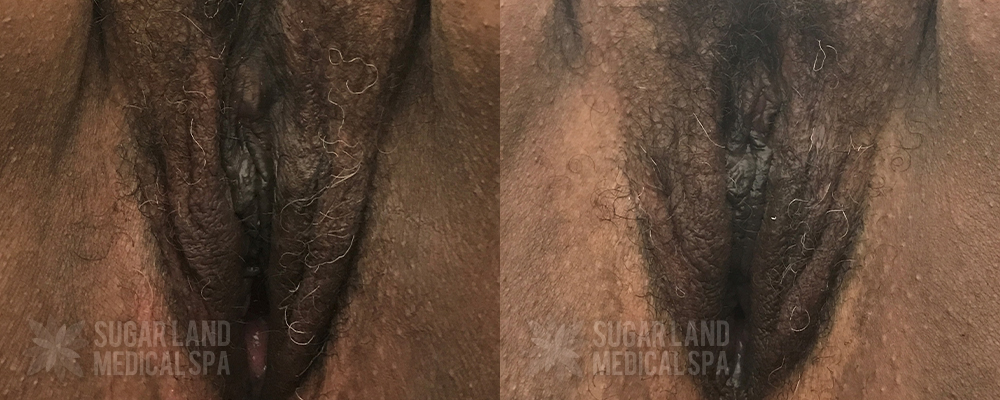 Patient 18 Non-Invasive Tightening Before and After