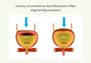urinary incontinence and reduction after vaginal rejuvenation sugar land