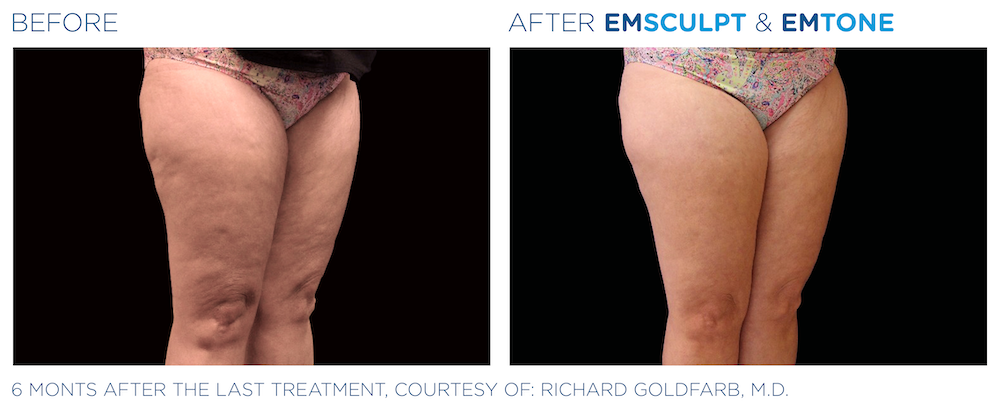 Before and After Emsulpt and Emtone Female Thighs