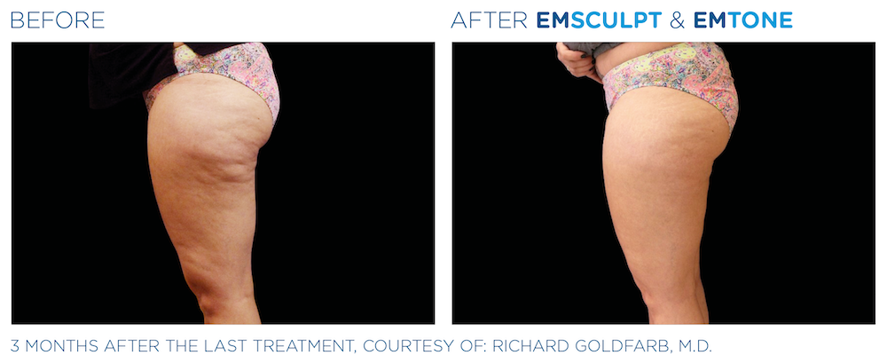 Before and After Emsulpt and Emtone Female Buttocks