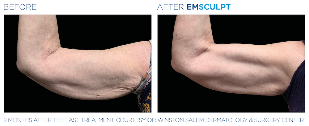 Before and After Emsulpt and Emtone Female Arms