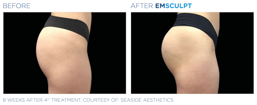 Before and After Emsulpt and Emtone Female Buttocks Card