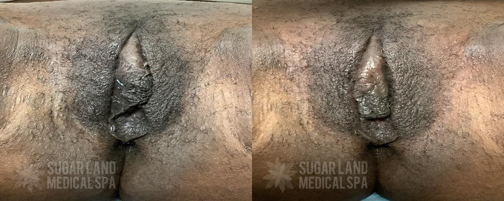 EMFEMME Sugar Land Med Spa Before and After