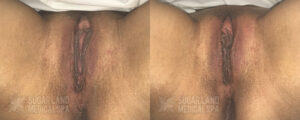 Sugarland Medical Spa EmFemme Patient 5 1st treatment