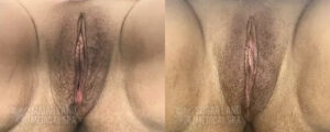 sugarland medspa before and afters EmFemme patient 1