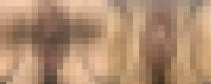 sugarland medspa before and afters EmFemme patient 1 pixilated