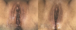 vaginoplasty patient3