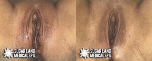 vaginoplasty patient3