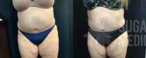 Sugar Land Medspa BodyCountour patient1