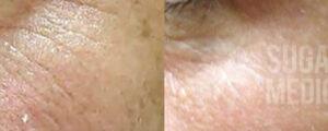 Sugar Land Medspa BA Microneedling Patient 1
