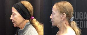 Neck Lift Sugar Land Med Spa Before and After