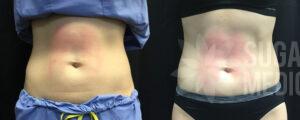 Sugar Land Medspa EmSculpt Patient6