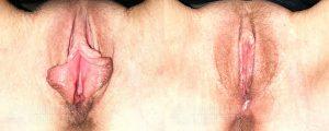 Sugarland Labiaplasty Patient CH