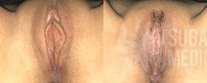 before after may clitoral hood reduciton 1a