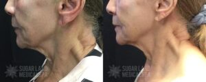 Patient 1a Exilis Sugar Land Med Spa Before and After