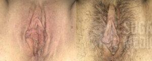 2024 09 Sugarland Vaginoplasty Patient CW