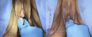 2024 11 Sugarland Vaginoplasty Patient 3
