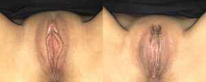 before after may clitoral hood reduciton 1a