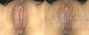 sugar before after labiaplastyclitoral hood reduction patient 1a