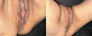 2025 01 Sugarland Labiaplasty Patient 15399