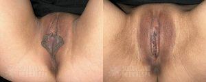 2025 01 Sugarland Labiaplasty Patient 15406